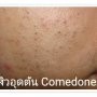 สิวอุดตัน Comedones