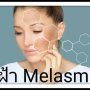 ฝ้า Melasma