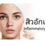 สิวอักเสบ (Inflammatory Acne)